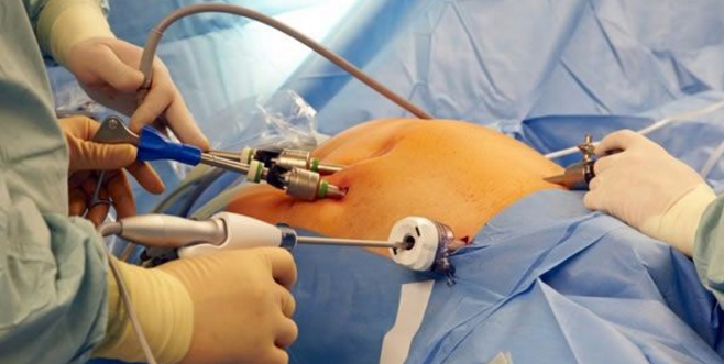 Cancro all'endometrio: a Borgosesia debutta una tecnica operatoria ... - InfoVercelli24
