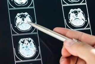 Ecco come il Long Covid cambia il cervello con meccanismi tipici dell'Alzheimer