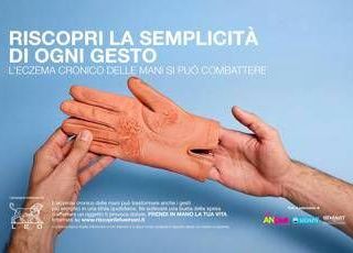 Mani che bruciano e fanno male, al via campagna su eczema cronico