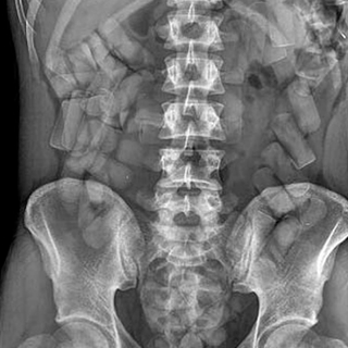 Nella pancia 88 ovuli di droga