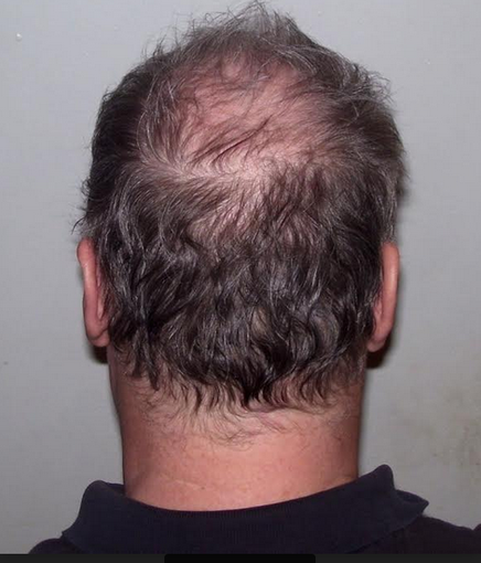 Trapianto di capelli: italiani sopra la media Trapianto di capelli: italiani sopra la media