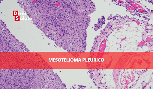 L’amianto uccide anche nella raffineria Kuwait di Napoli L’amianto uccide anche nella raffineria Kuwait di Napoli