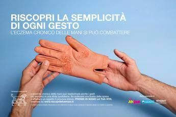 Mani che bruciano e fanno male, al via campagna su eczema cronico Mani che bruciano e fanno male, al via campagna su eczema cronico