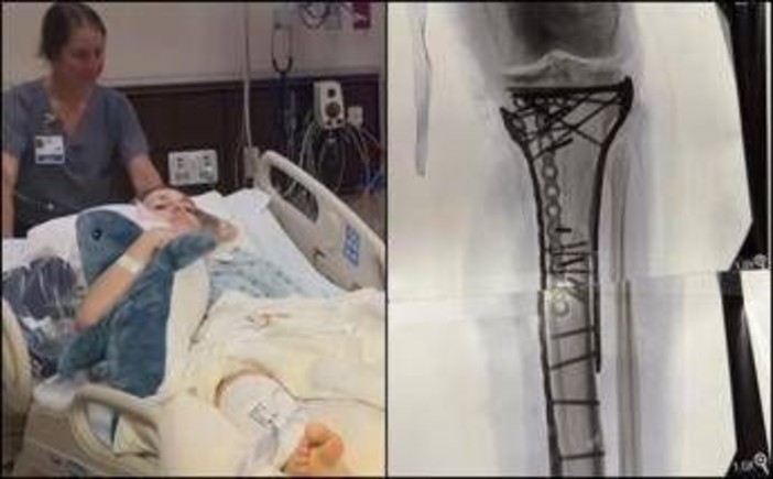 Milano Cortina, Vonn mostra la gamba dopo le operazioni: "Dolore difficile da gestire"