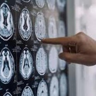 Malattia di Parkinson, ok in Europa a formulazione orale Ld/Cd a rilascio modificato