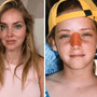 Chiara Ferragni, l'intervento al naso: "Ecco perché è storto ora" Chiara Ferragni, l'intervento al naso: "Ecco perché è storto ora"