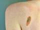 Imi: "Bene legge su prevenzione melanoma, educare i giovani su rischi"
