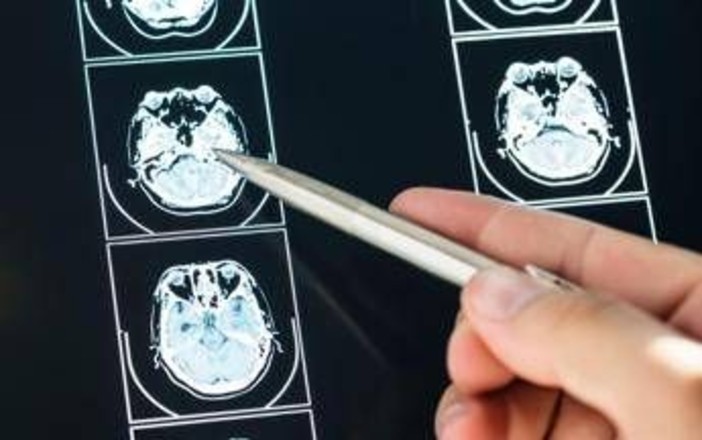 Ecco come il Long Covid cambia il cervello con meccanismi tipici dell'Alzheimer