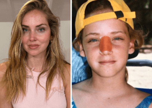 Chiara Ferragni, l'intervento al naso: "Ecco perché è storto ora"