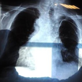 Cancro al polmone aggressivo, combinazione farmaci riduce del 58% rischio morte Cancro al polmone aggressivo, combinazione farmaci riduce del 58% rischio morte