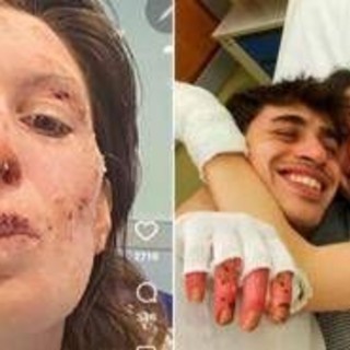Crans-Montana, oggi dimessi due ragazzi. Eleonora Palmieri mostra le ustioni sui social