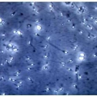 Microplastiche nella prostata e nel liquido seminale, la scoperta italiana: cosa comporta Microplastiche nella prostata e nel liquido seminale, la scoperta italiana: cosa comporta